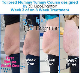 3D Lipo Brighton