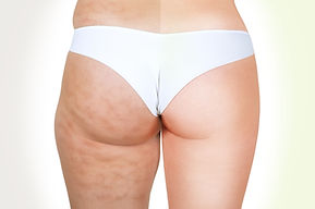 cellulite reduction Jayen