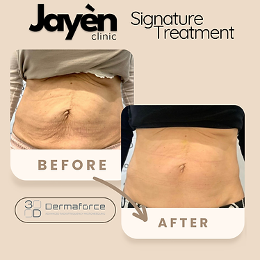 Before and after results of Dermaforce RF Microneedling