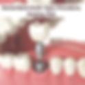 Dental Bone Graft: Type, Procedure, Healing, Risk
