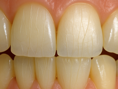 Understanding Craze Lines Teeth Health
