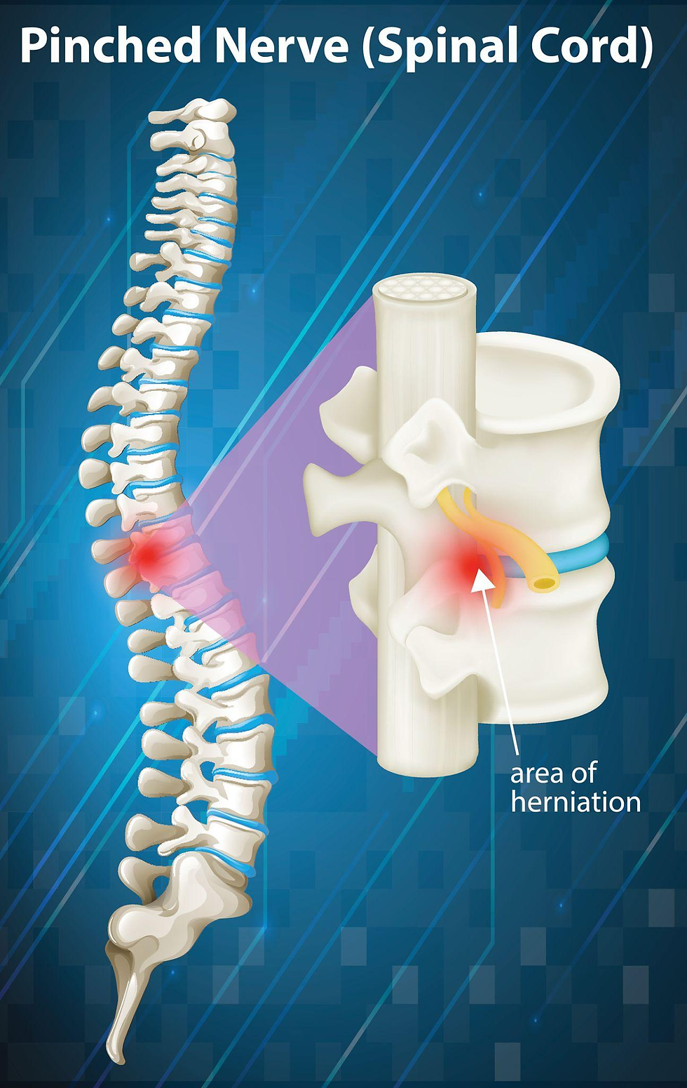 Diagram of spinal cord with highlighted red area showing a pinched nerve. Text reads "Pinched Nerve (Spinal Cord)" and "area of herniation".