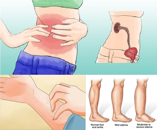 5 indicios que indican que posiblemente padezca de enfermedad renal!