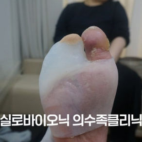엄지발가락 실리콘 의족 제작