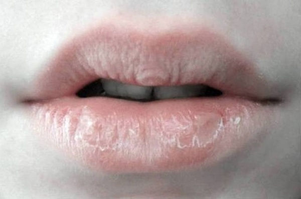 Chapped lips