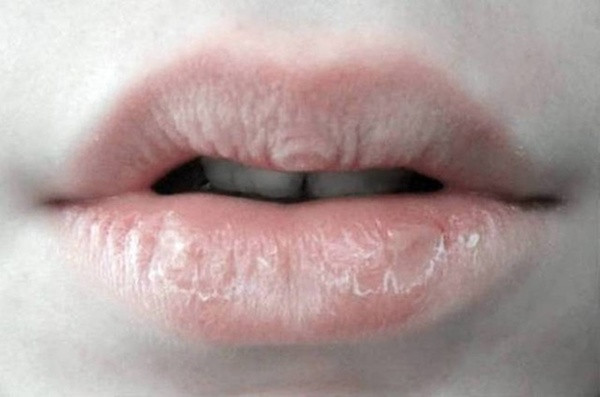 Chapped lips