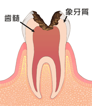 神経まで達するむし歯