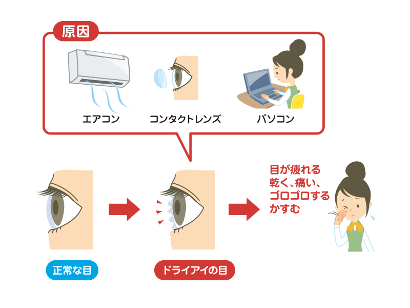 イラストレーション_ドライアイ