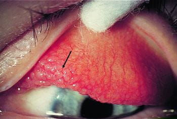 Allergic Eye Disease