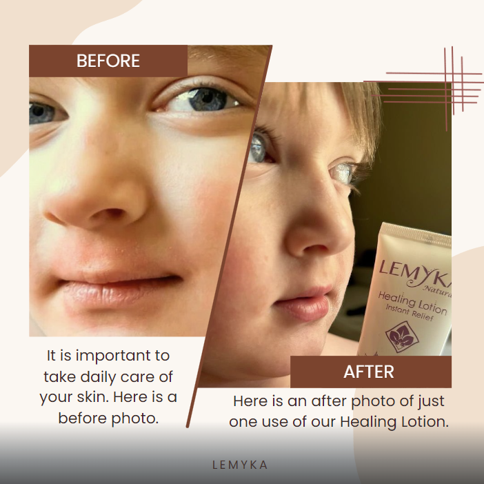 Thumbnail: Natural Facial Rash Healing Lotion | Rosacea Soothing Moisturizing | Non-greasy