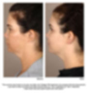 Before and after image of a woman's face treated with Collagen P.I.N. Microneedling for pigment