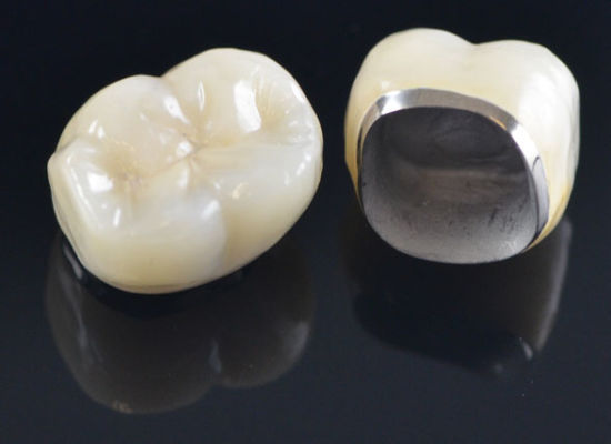 dental crowns on a black surface, one top view and one showing a silver metal underside.