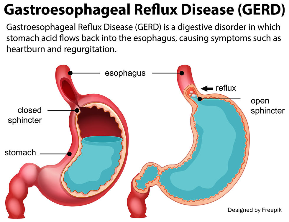 Gastroesophageal Reflux Disease (GERD) diagram.
