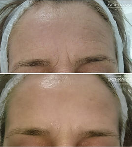 peeling vegetal naturel anti age, anti rides