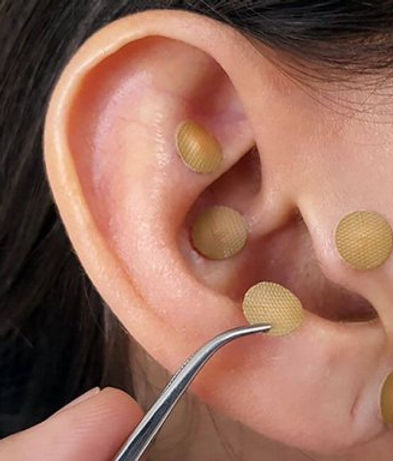 auriculoterapia-obesidad-sobrepeso-e1541