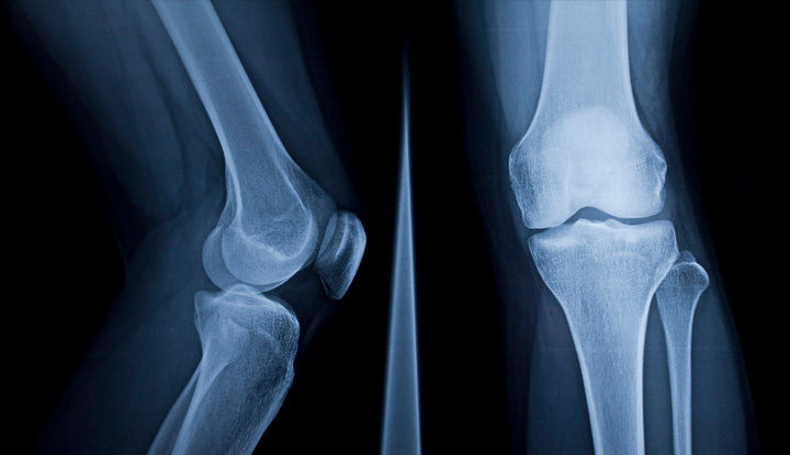 23501-knee-x-ray.jpg