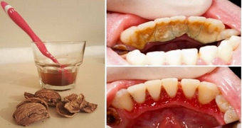GET RID OF TARTAR'S FOREVER....