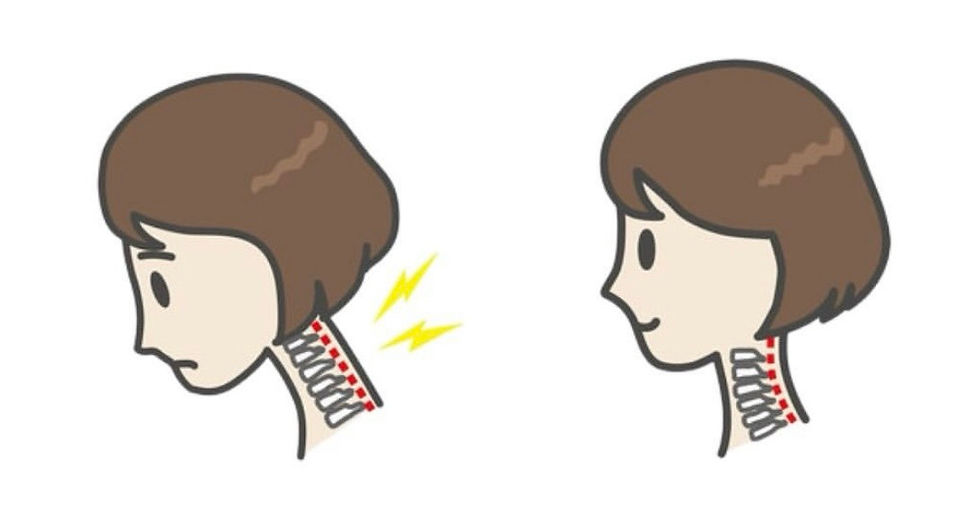 ストレートネックを現すイラスト。