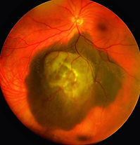 chroidal melanoma (ocular oncolgy).jpeg