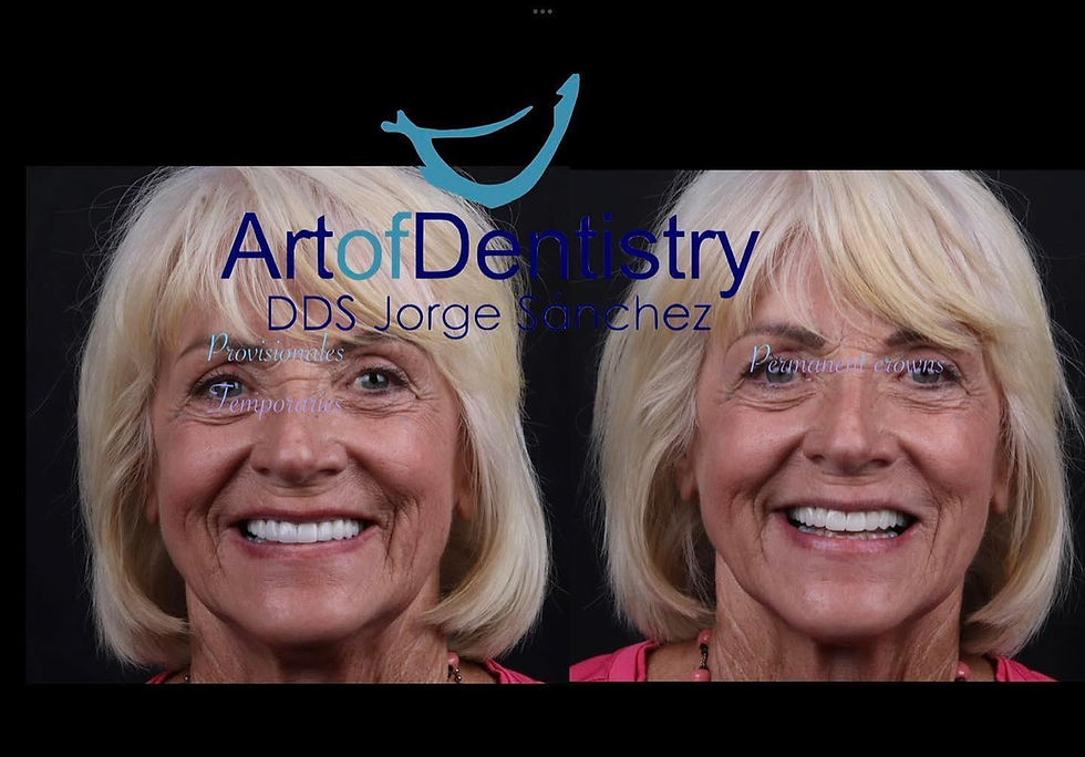 Before and After Crowns
