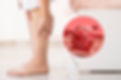 capa-sclerotherapy.jpg