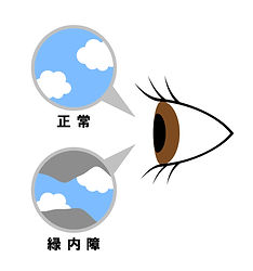 緑内障