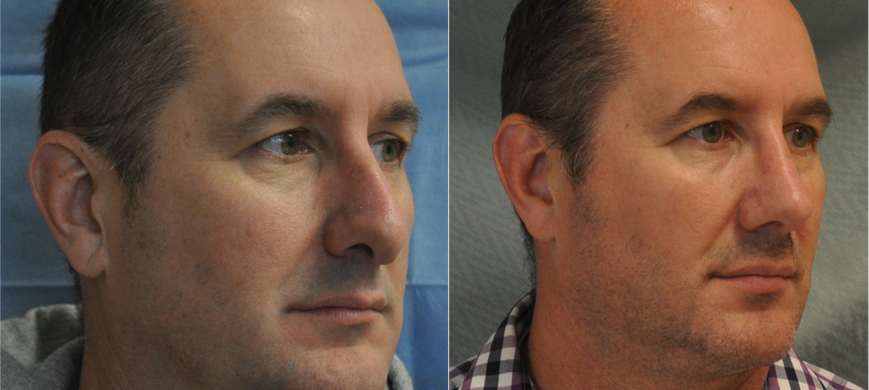 Tarashansky Rhinoplasty