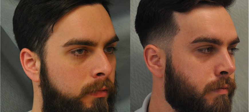 New York Rhinoplasty