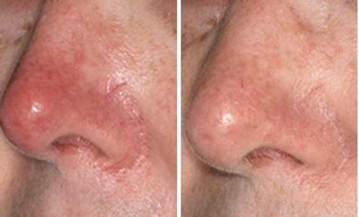 rosacea_edited.jpg