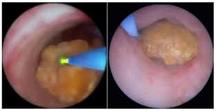 Cirurgia laser para cálculos renais - Como é isso ?