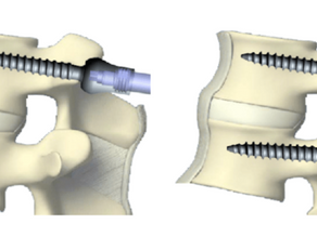 Pedicle Screw Insertion: Why take Unnecessary Risks when the Technology already exists? 