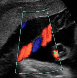 Cordão umbilical - Doppler