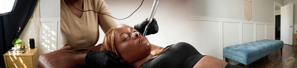 Microneedling With PRP_edited.jpg