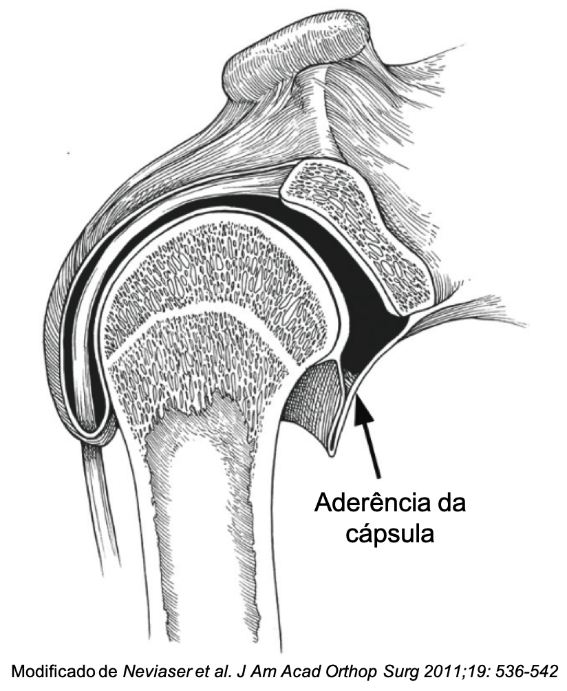 Aderência da cápsula articular glenoumeral no ombro congelado - capsulite adesiva