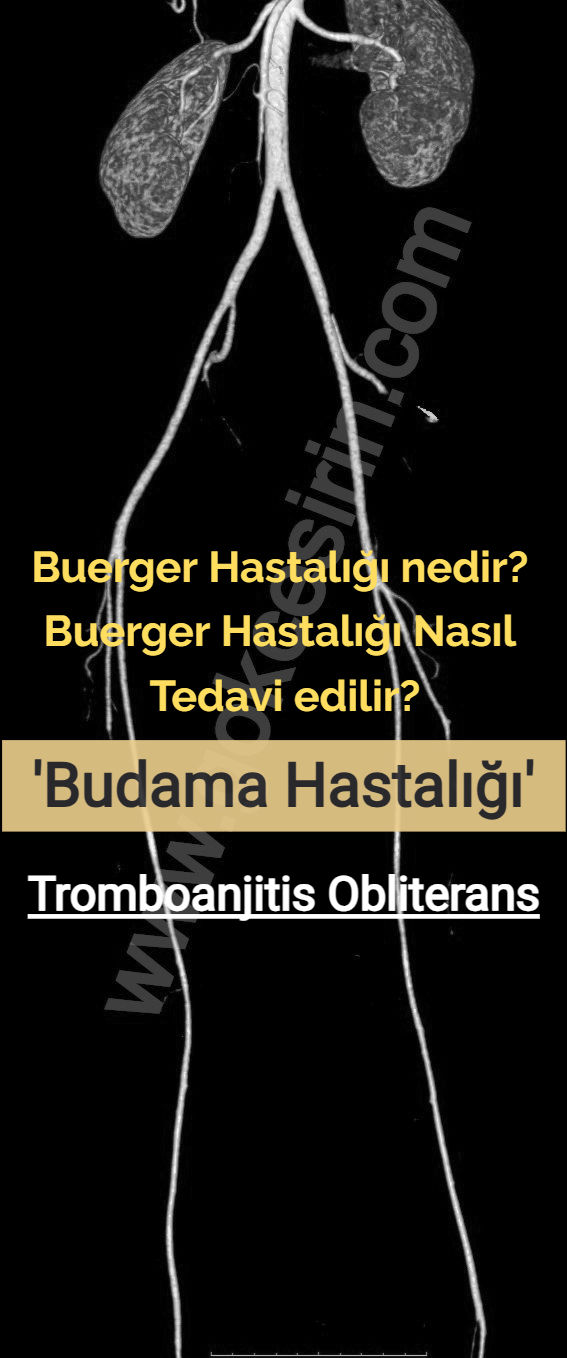 Buerger Hastalığı Nedir? Buerger Hastalığının Belirtileri Nelerdir? Buerger Hastalığı Kimlerde Görülür? Buerger hastalığı nasıl tedavi edilir?