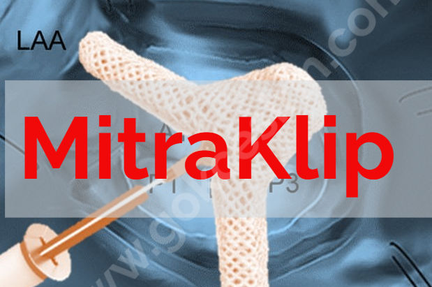 MitraKlip, ciddi mitral yetersizliği (MY) bulunan ve cerrahi tedavi için yüksek risk taşıyan veya cerrahiye uygun olmayan hastalarda mitral kapak fonksiyonunu iyileştirmek amacıyla kullanılan transkateter kenar-kenara onarım (TEER) cihazıdır.