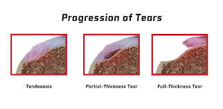 Partial Thickness Rotator Cuff Tears