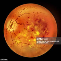 Comprehensive Diabetic Retinopathy Care at Titanium Eye Care