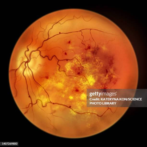 Comprehensive Diabetic Retinopathy Care at Titanium Eye Care