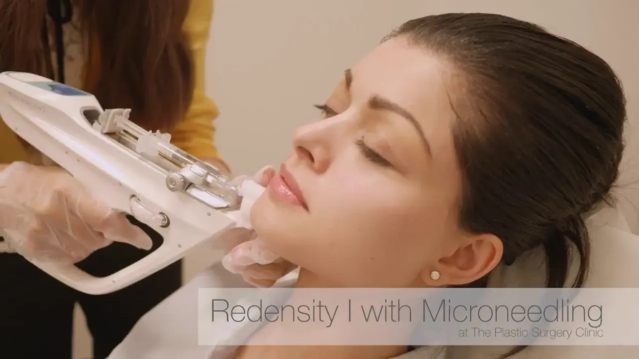 Microneedling with NCTF 135 HA