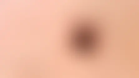 Kene ısırığında erken müdahale hayat kurtarıyor