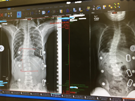 Scoliosis, Surgery and Energy Healing