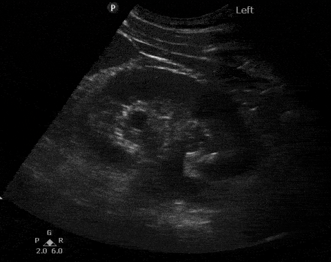 H01 Mild hydronephrosis.gif