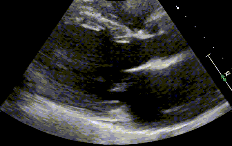 MR prolapse Ant mitral valve Ap4c Plx.gif