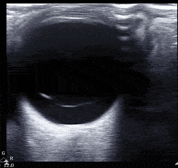 EDITED vitreous detachment.gif