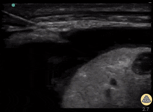 needle guidance thoracentesis the pocus atlas.gif
