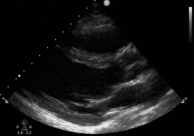 end diastole Plx.gif