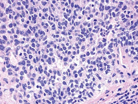 What is Ewing's Sarcoma? 