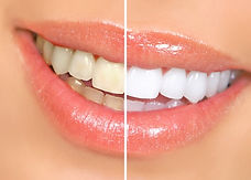 sbiancamento-denti-mascherine.jpeg