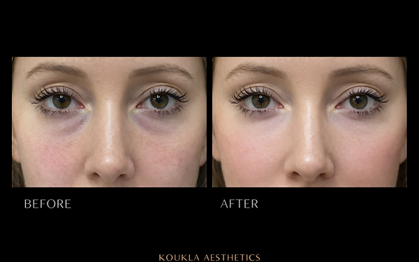 PRP UNDER EYE TREATMENT